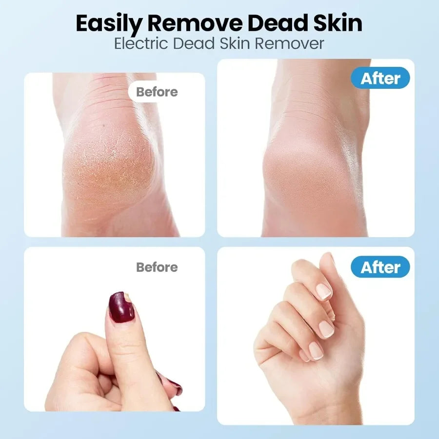 TLXT Electric Callus Remover 2 in 1 Rechargeable Foot File
